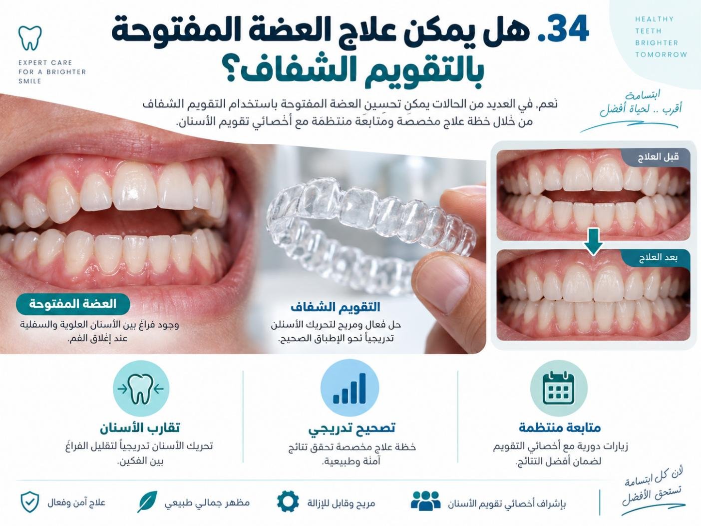 هل يمكن علاج العضة المفتوحة بالتقويم الشفاف؟