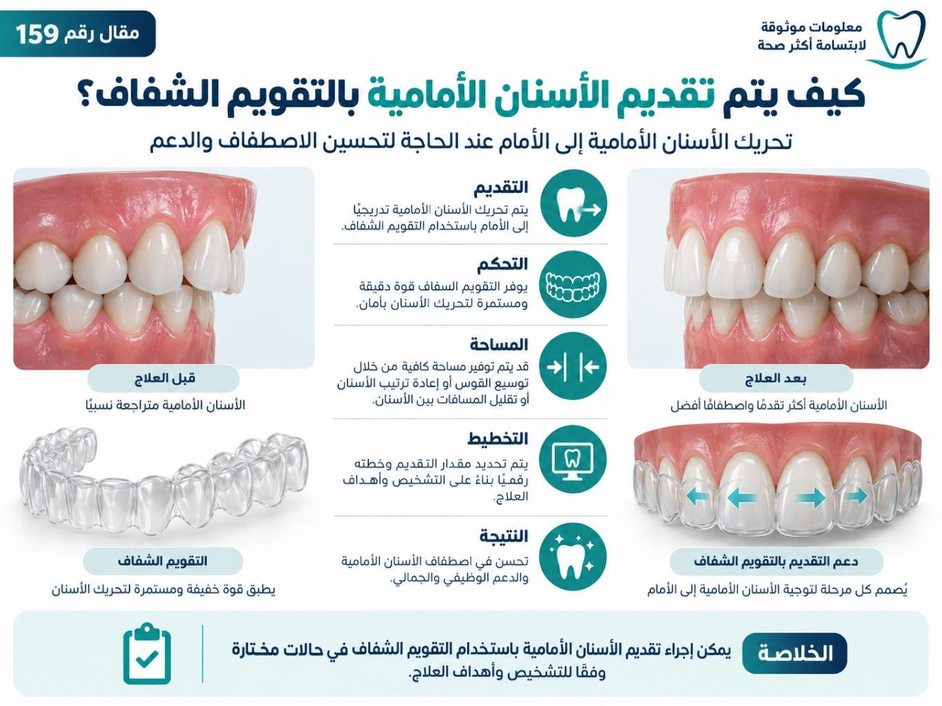كيف يتم تقديم الأسنان الأمامية بالتقويم الشفاف؟
