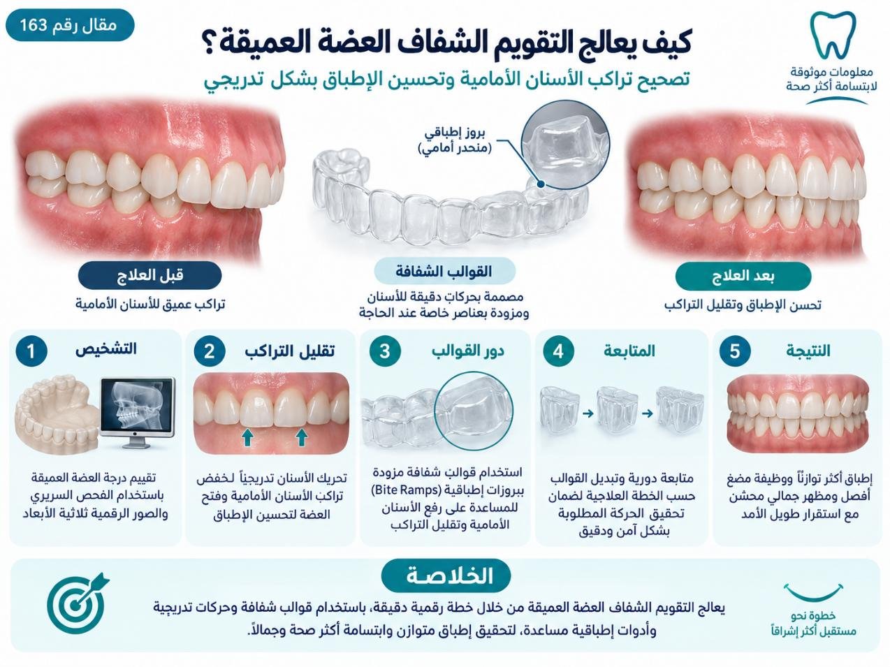 كيف يعالج التقويم الشفاف العضة العميقة؟