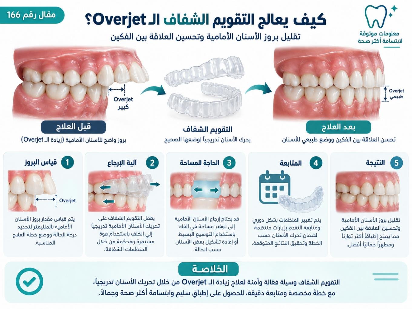 كيف يعالج التقويم الشفاف الـ Overjet؟