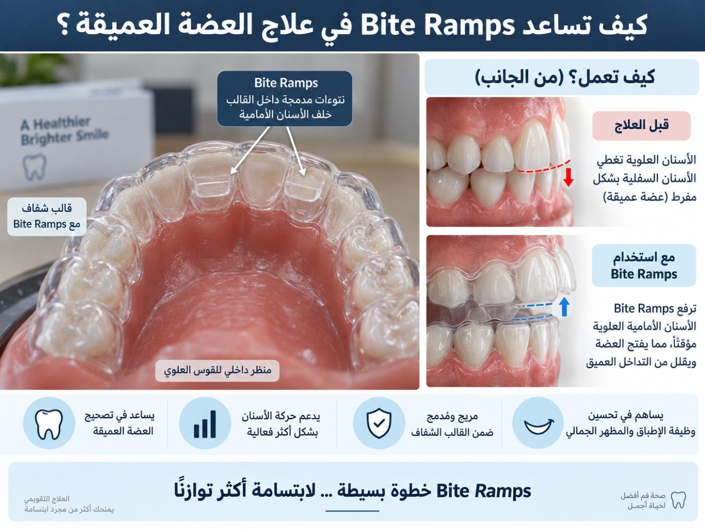 كيف تساعد Bite Ramps في علاج العضة العميقة؟