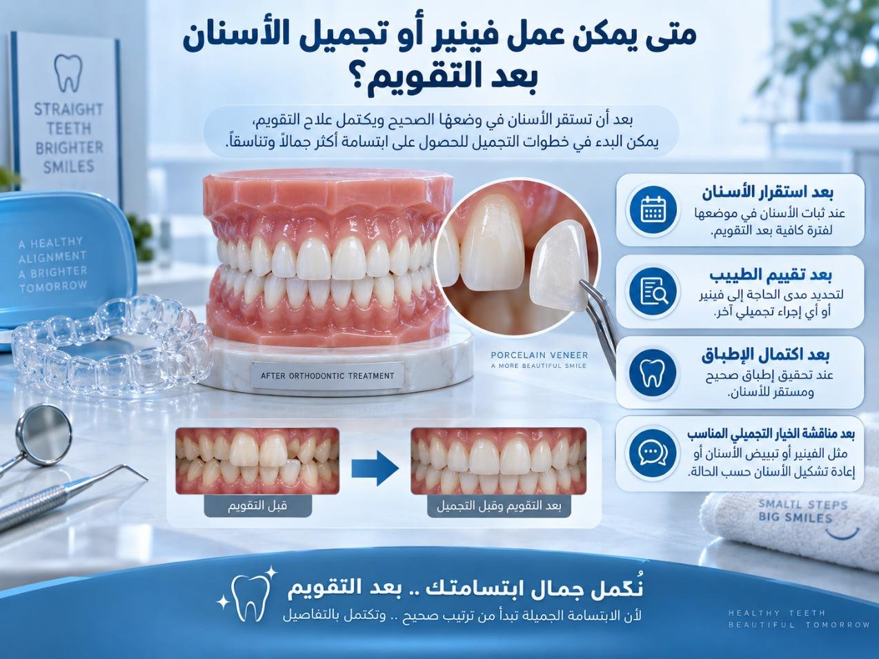 متى يمكن عمل فينير أو تجميل الأسنان بعد التقويم؟