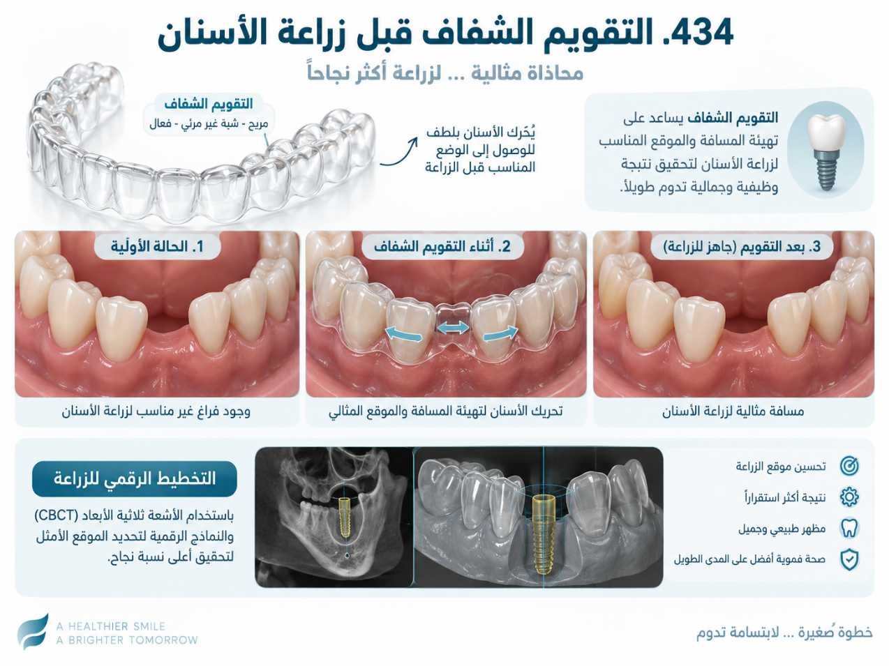 التقويم الشفاف قبل زراعة الأسنان