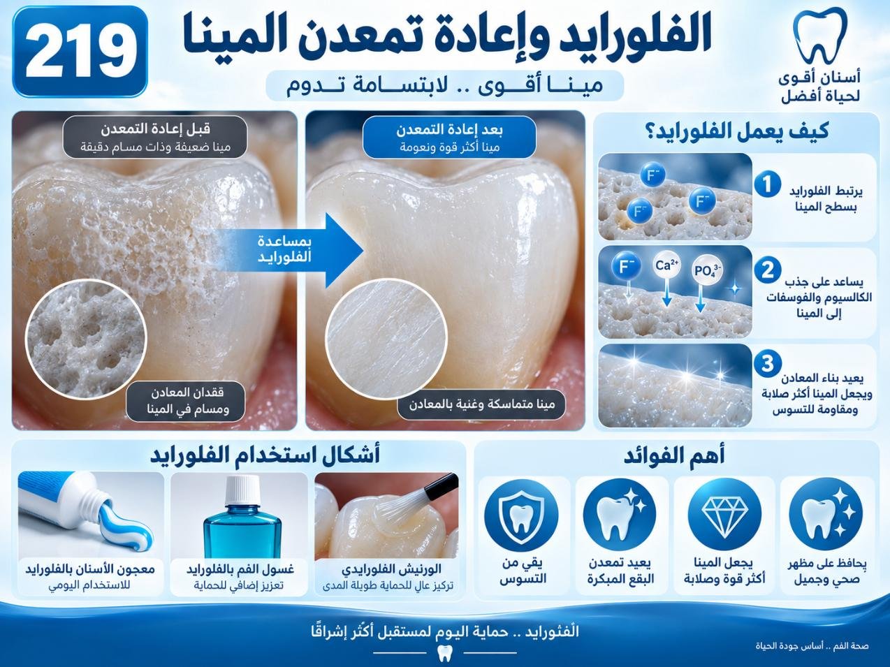 الفلورايد وإعادة تمعدن المينا: الدواعي والخيارات والعناية