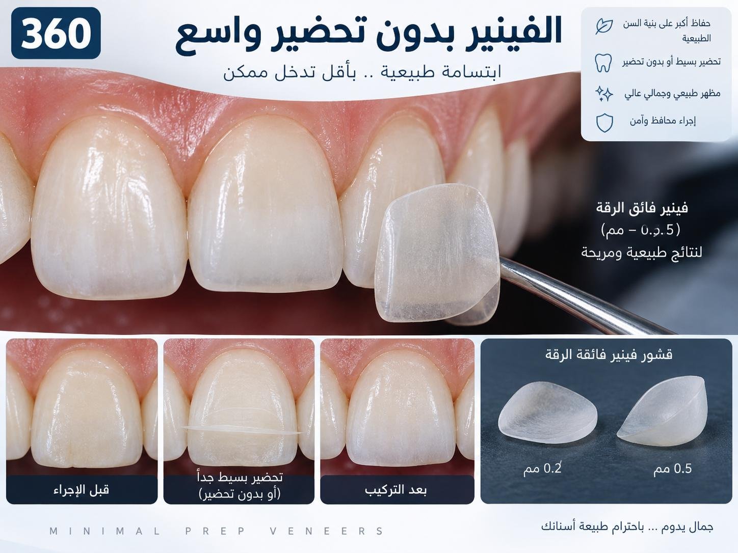 الفينير بدون تحضير واسع: الخيارات والنتائج والعناية